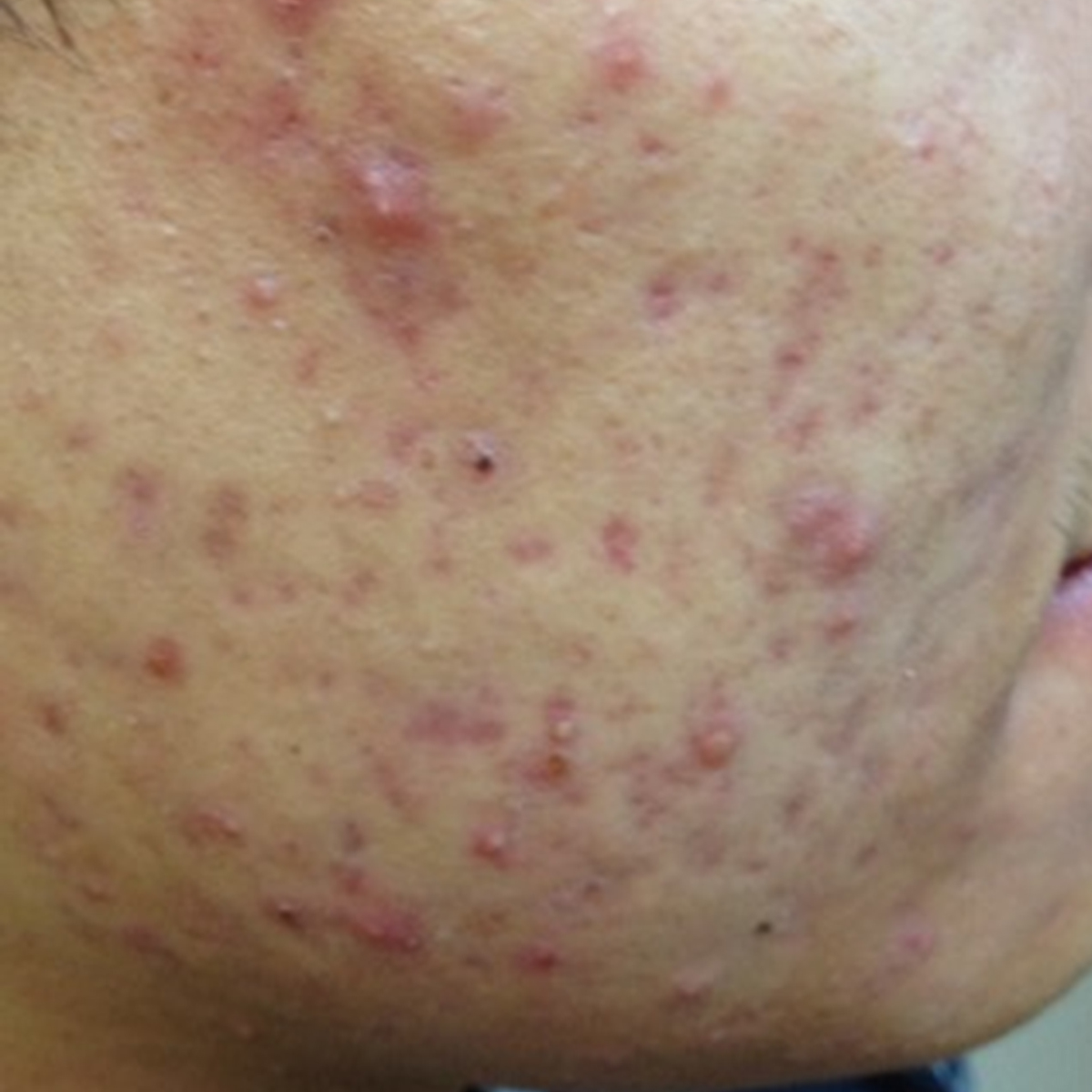 Soemantri Ästhetik Institut, Lüdenscheid, SkinPen, Medizinisches Microneedling, Gesichtsbehandlung, Premium, NRW